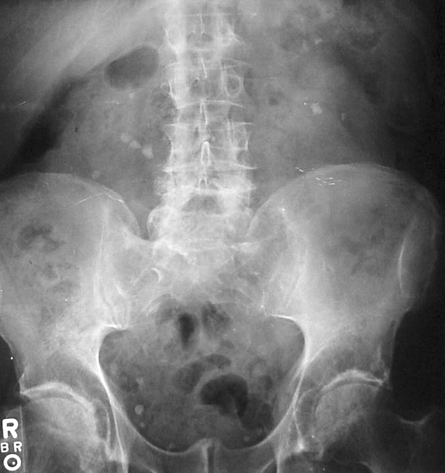 AP supine abdominal radiograph showing normal bowel gas pattern, with visible psoas margins and kidney shadows