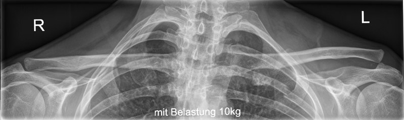 Weight-bearing AP radiograph of the shoulder girdle showing a left Rockwood Type 3 acromioclavicular joint dislocation, with the clavicle elevated relative to the acromion