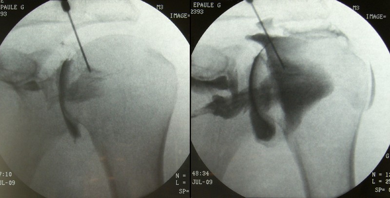 Shoulder arthrogram radiograph showing iodinated contrast filling the glenohumeral joint