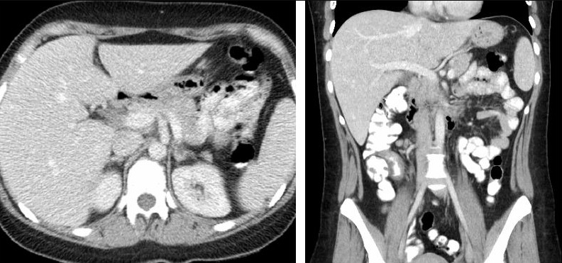 Normal contrast-enhanced abdominal CT scan showing opacified vasculature and organs after intravenous contrast administration