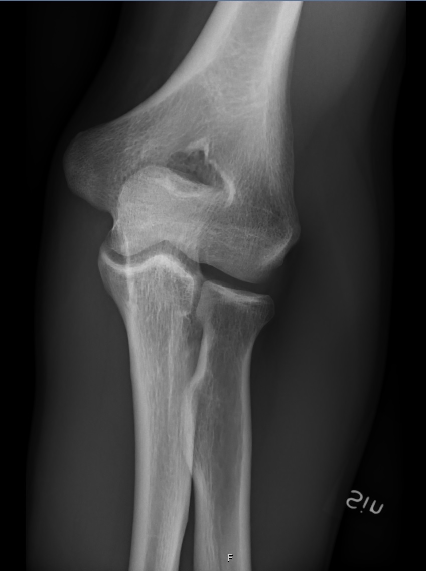 AP radiograph of a normal elbow joint demonstrating the distal humerus, radial head, and proximal ulna