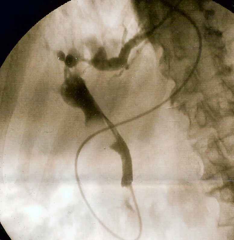 Fluoroscopic ERCP image showing iodinated contrast filling the common bile duct with a stone