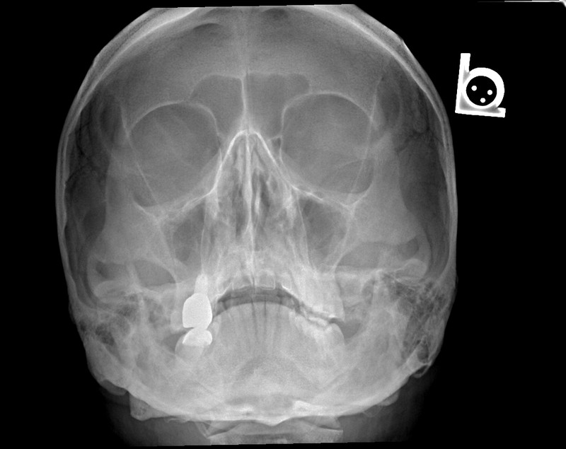 Waters view (occipitomental projection) radiograph of the paranasal sinuses and facial bones