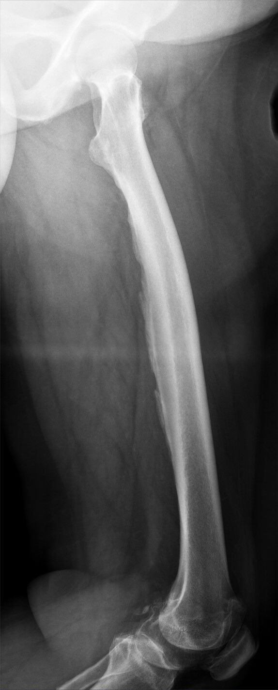AP radiograph of the entire femur demonstrating the femoral shaft from hip to knee joint