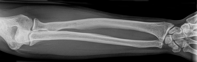 AP radiograph of the forearm showing the radius and ulna bones