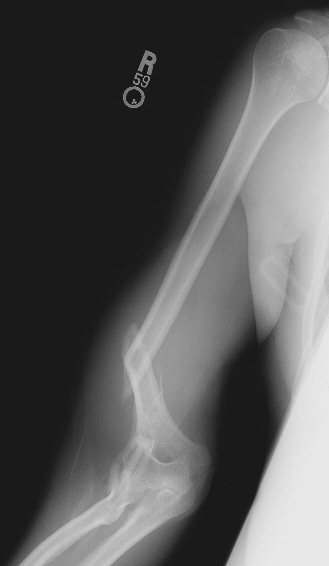 AP radiograph of the right humerus showing a displaced mid-shaft fracture, with the shoulder and elbow joints visible