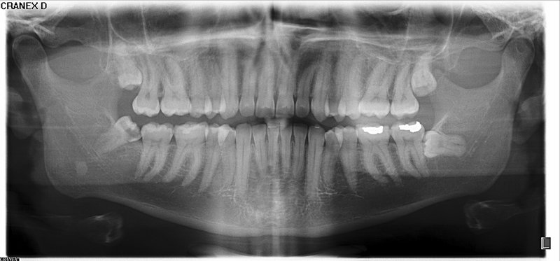 Panoramic radiograph (orthopantomogram) demonstrating the complete mandible, temporomandibular joints, and teeth