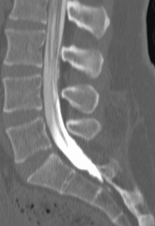Post-myelogram CT showing iodinated contrast filling the thecal sac in the spinal canal
