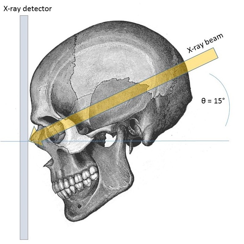 Positioning diagram of the PA axial Caldwell view of the skull and orbits with 15 degree caudal beam angulation