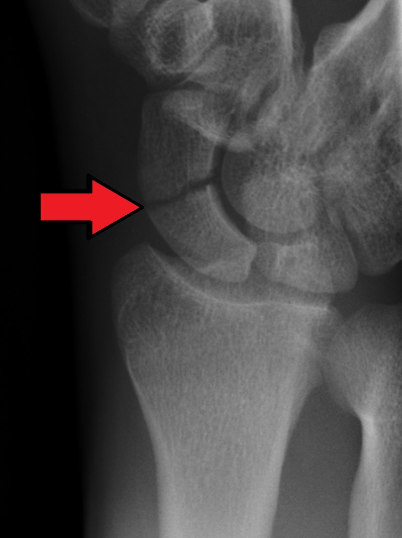 Wrist radiograph showing a fracture across the waist of the scaphoid bone, indicated by an arrow