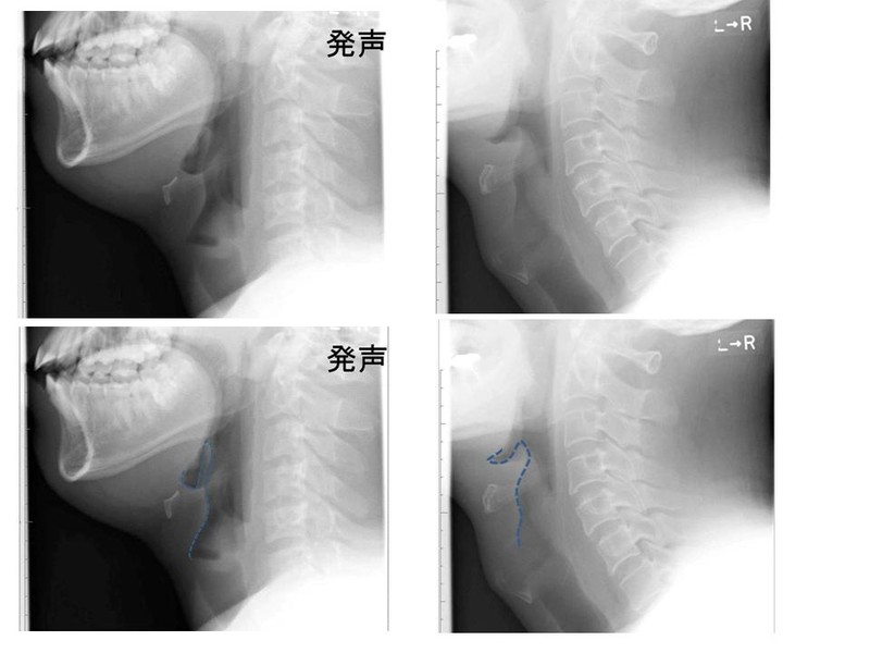 Comparison of lateral soft tissue neck radiographs showing a normal thin epiglottis on the left and a swollen, rounded epiglottis (thumb sign) in epiglottitis on the right