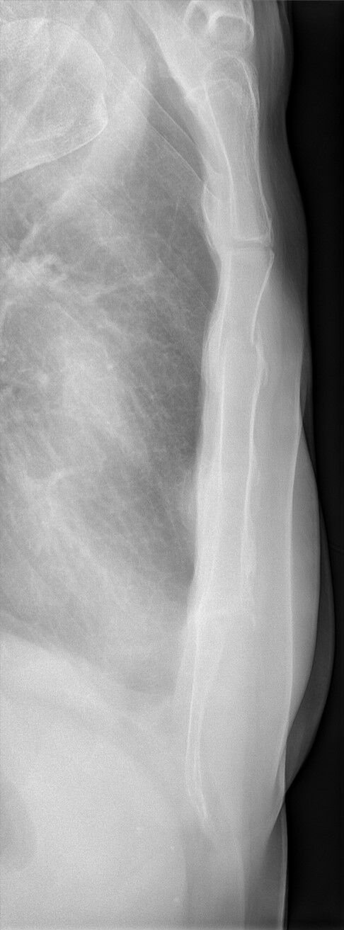 Sternum X-Ray Positioning: RAO and Lateral Views — Radiography 101