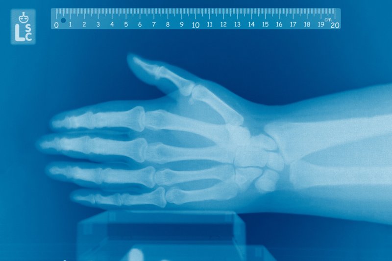 PA radiograph of a normal hand demonstrating metacarpal and phalangeal anatomy