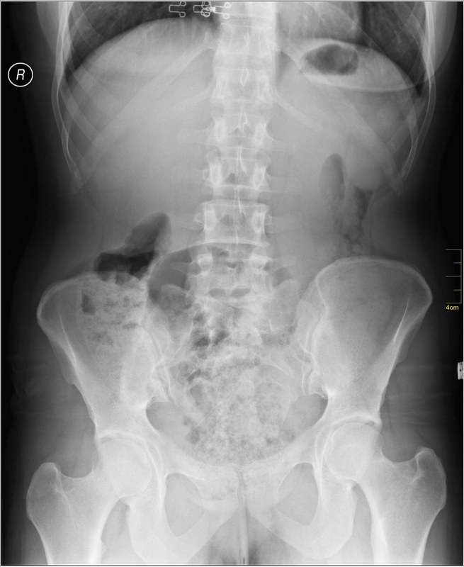 An AP abdominal radiograph showing clear collimation borders — the dark unexposed margins around the exposed anatomical field