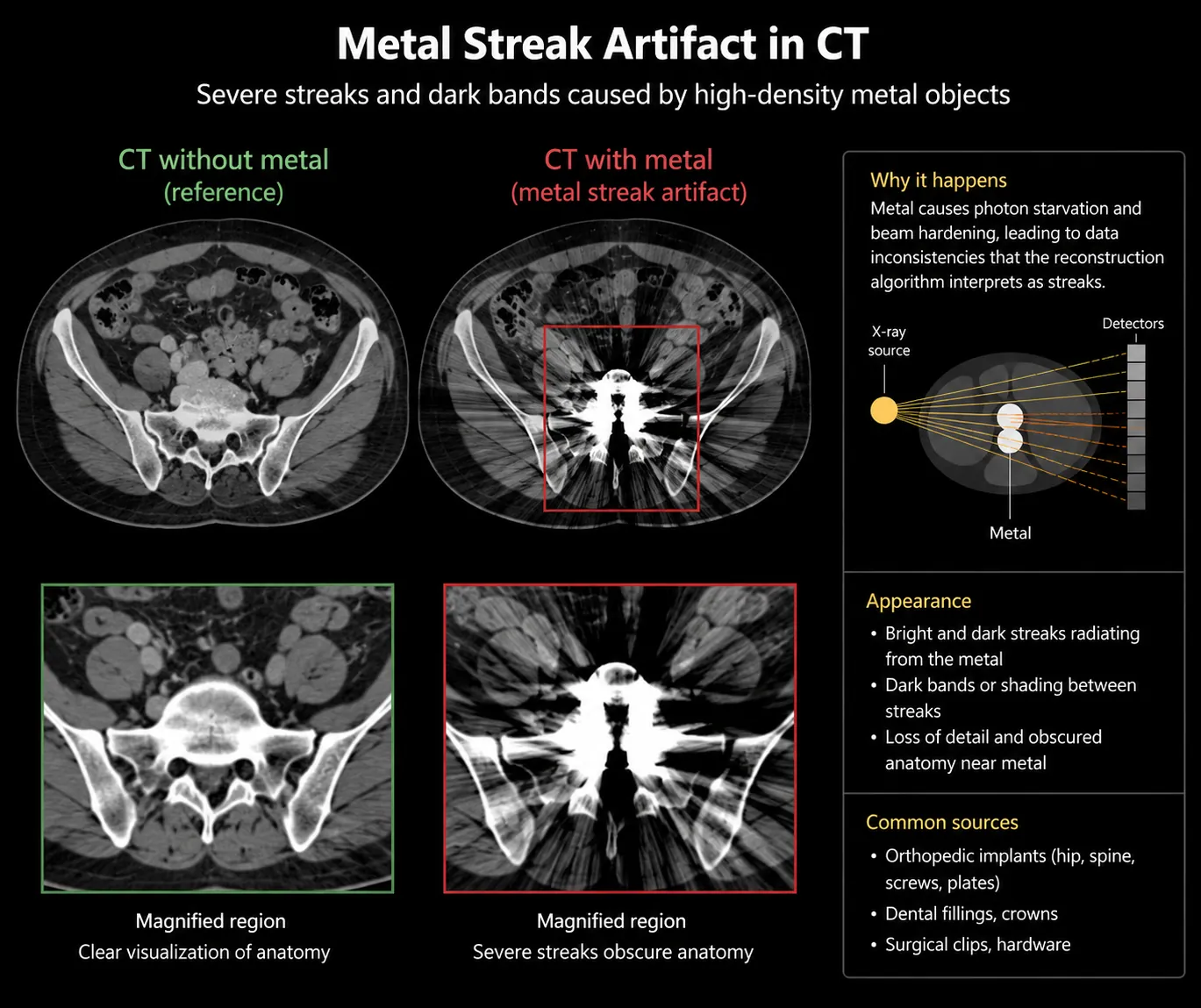 Metal streak CT artifact infographic