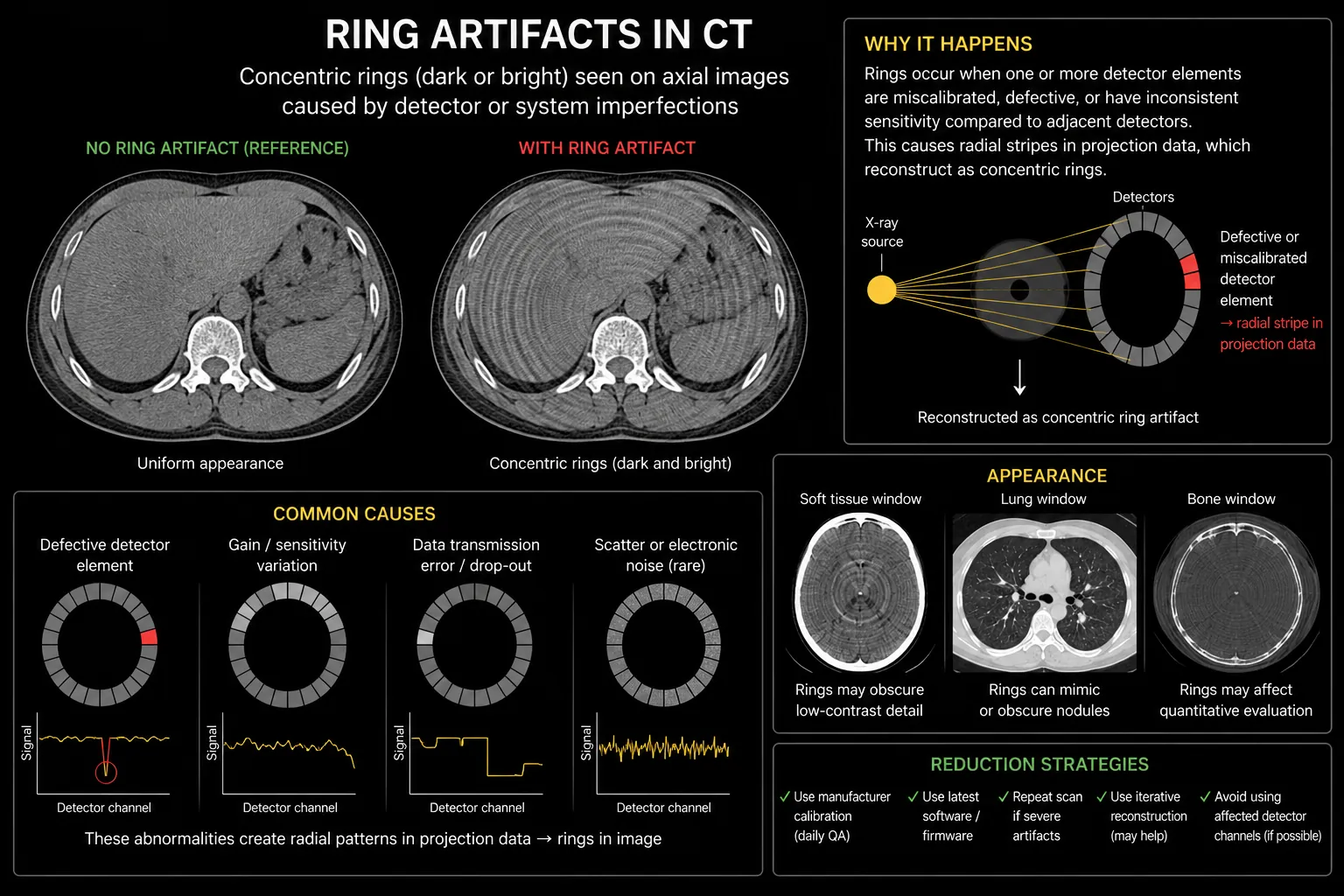 Ring CT artifact infographic