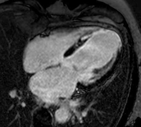 Cardiac MRI 4-chamber late gadolinium enhancement showing inferior myocardial infarction