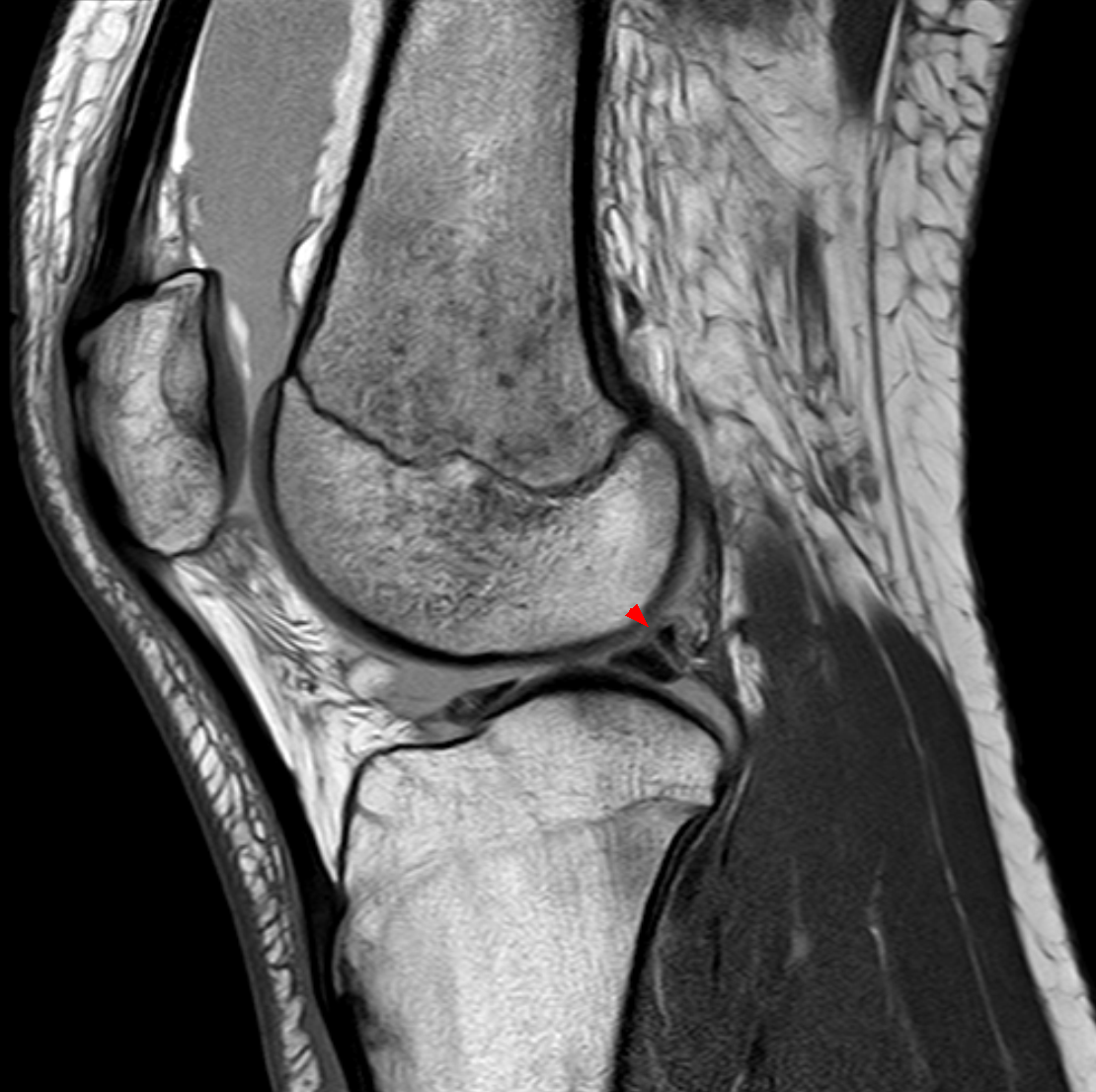 Sagittal knee MRI showing meniscofemoral ligament and joint anatomy