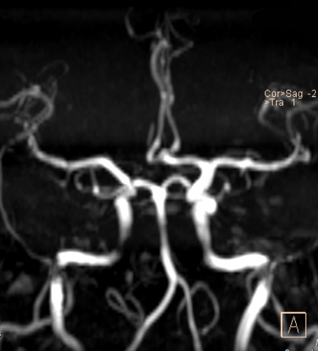 MRA maximum intensity projection showing Circle of Willis cerebral arteries