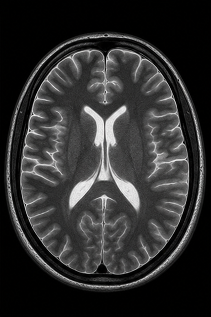 Generated axial T2-weighted brain MRI scan with bright CSF and fluid signal