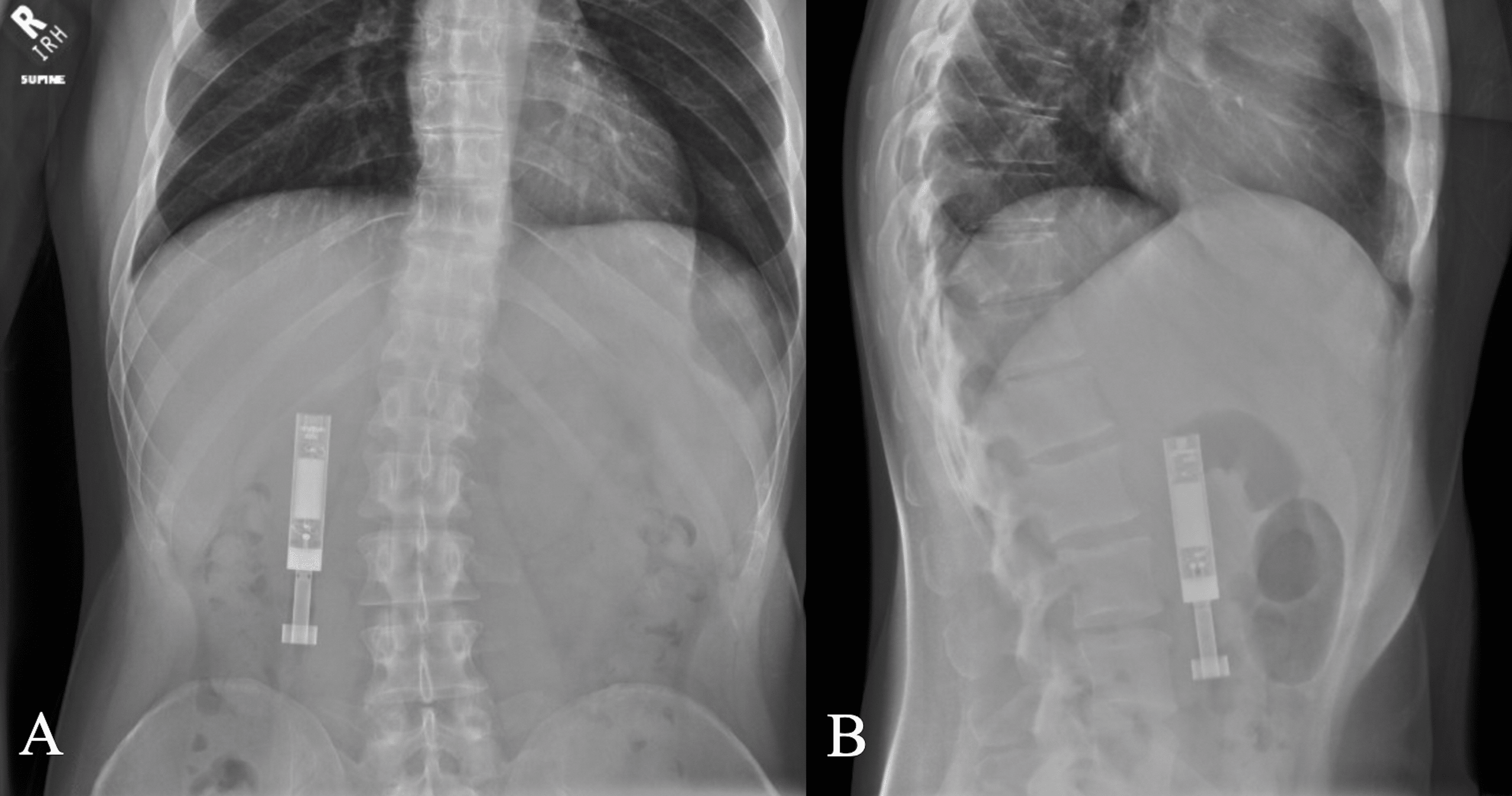 Abdominal plain film X-ray