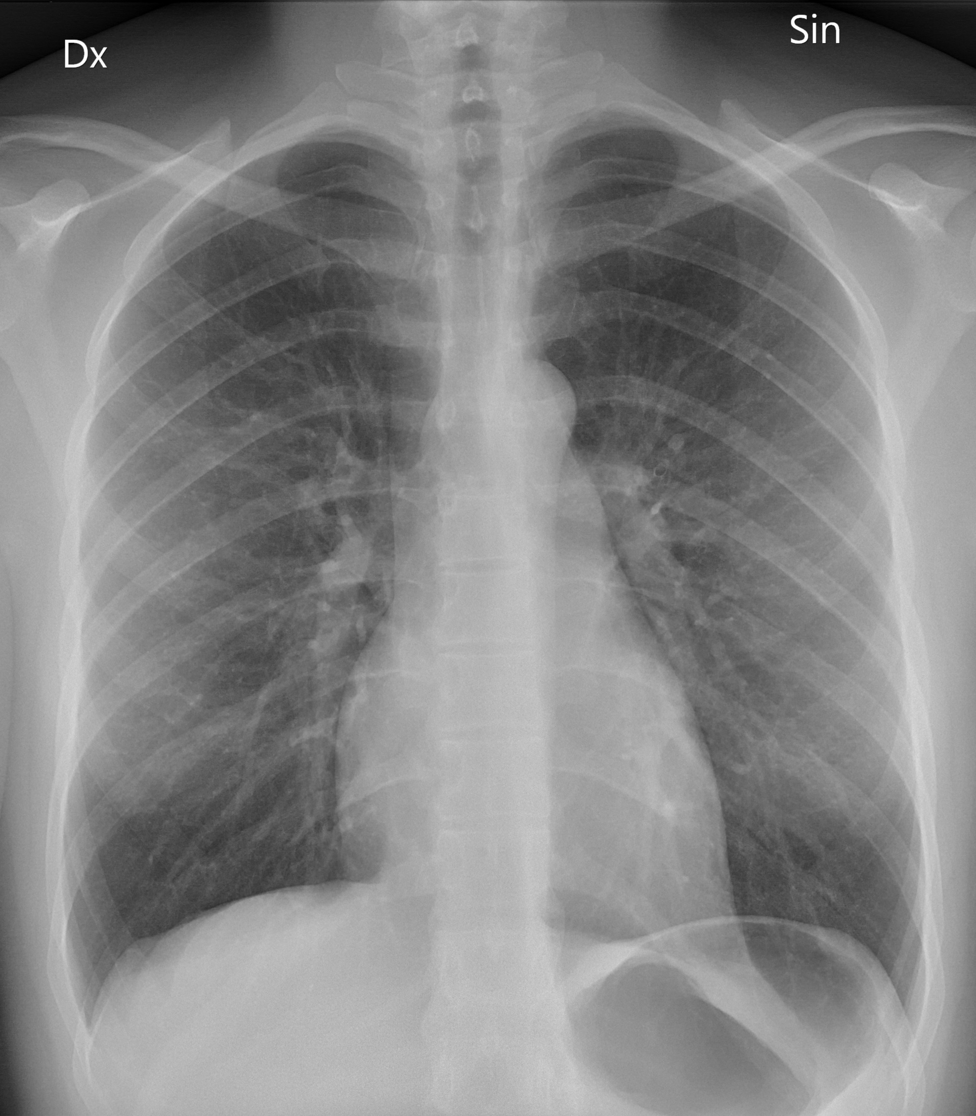 Normal PA chest X-ray