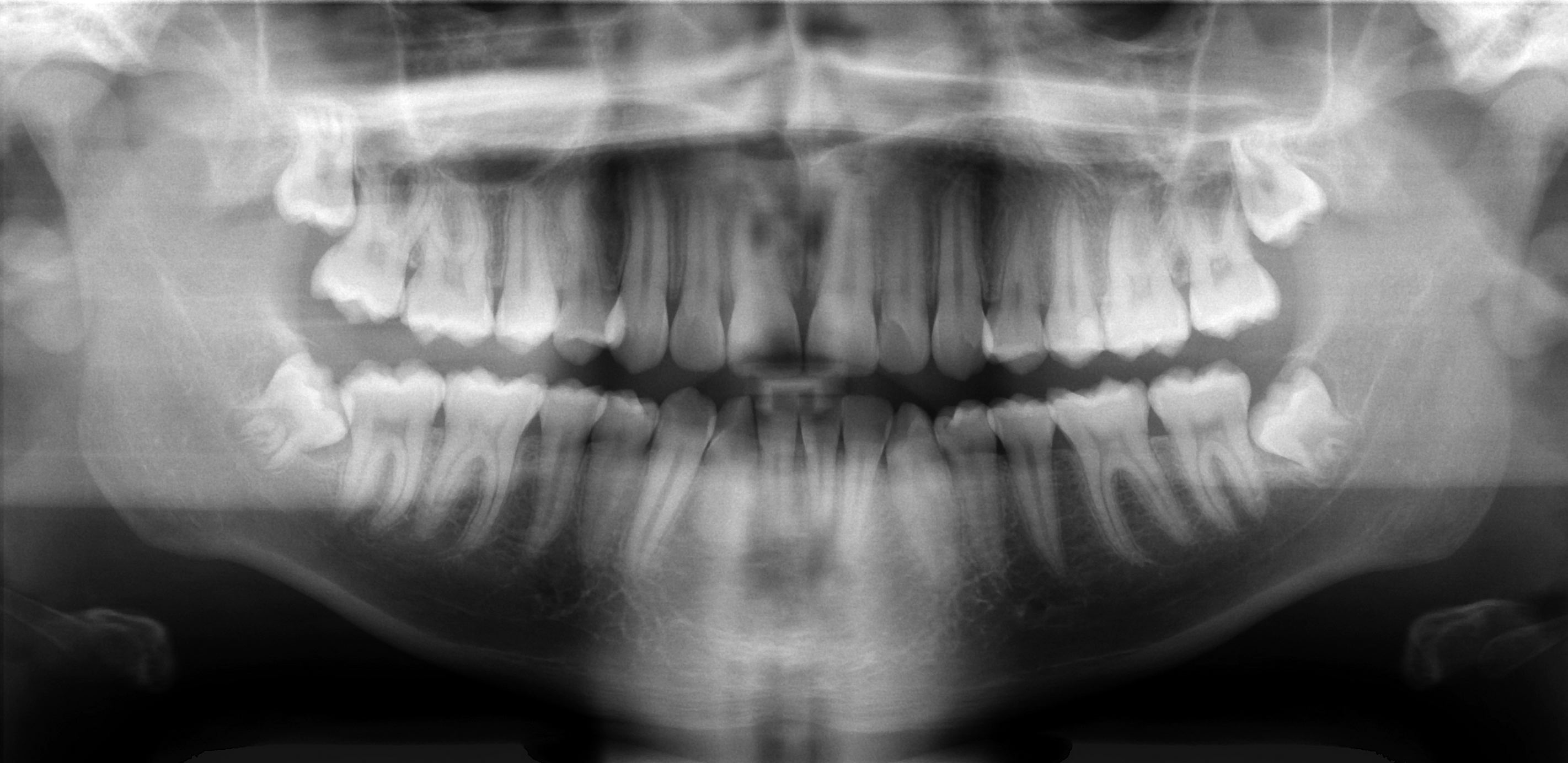 Dental panoramic X-ray