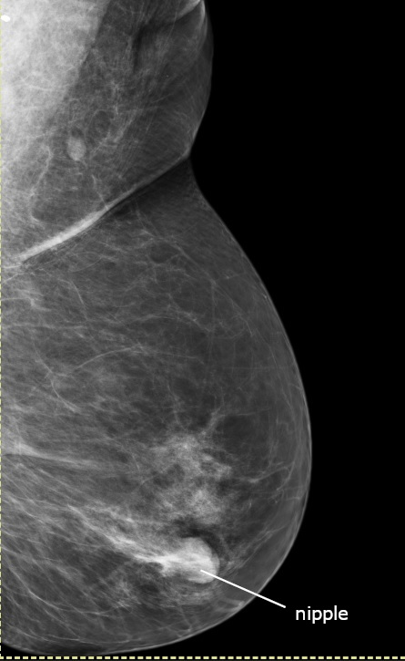 Normal mammography MLO view