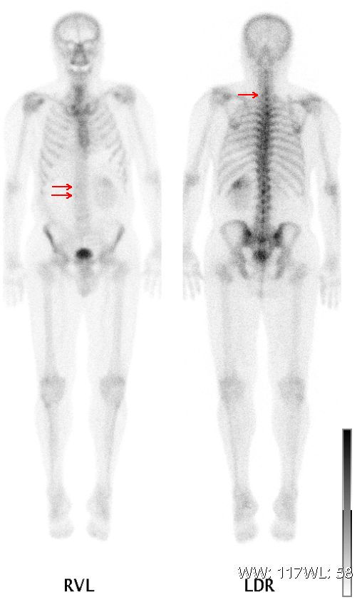 Whole-body nuclear medicine bone scan showing skeletal radiotracer uptake