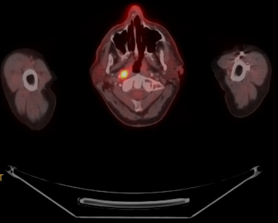 FDG PET/CT transverse slice showing radiotracer-avid nasopharyngeal cancer