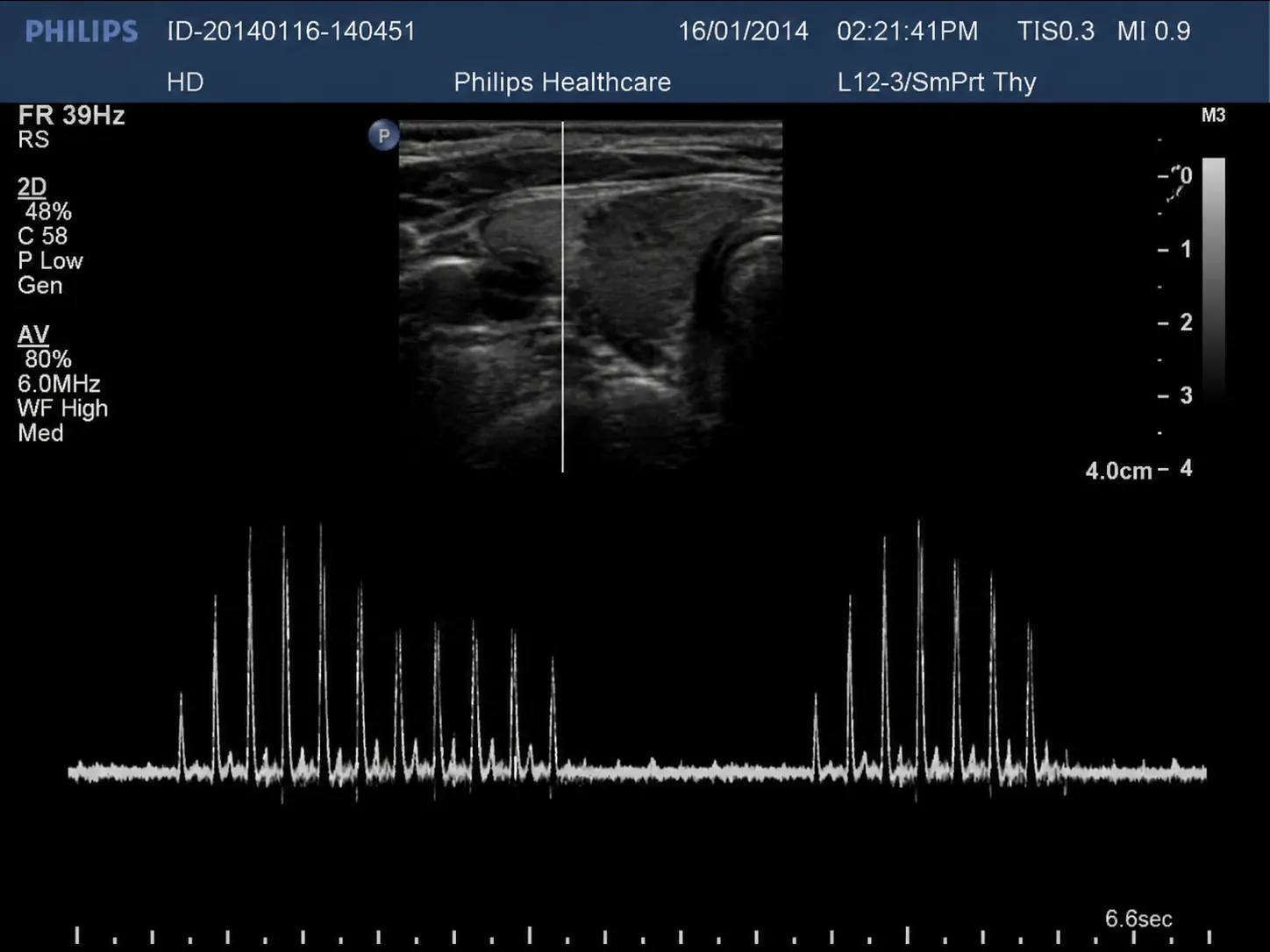 A-mode ultrasound monitor display with echo amplitude spikes beneath a grayscale thyroid scan.