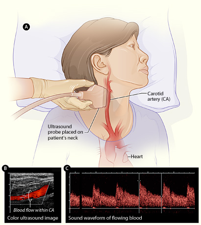 Carotid Doppler ultrasound image with color flow and waveform