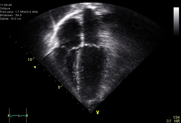 Four-chamber echocardiogram ultrasound image of the heart